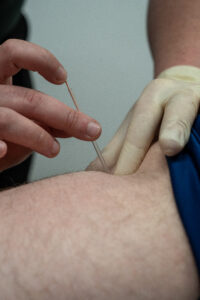 Dry Needling